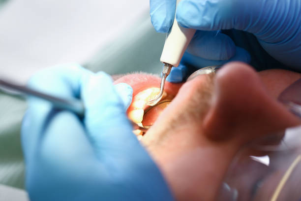 Best Emergency Root Canal Treatment in Ashaway, RI