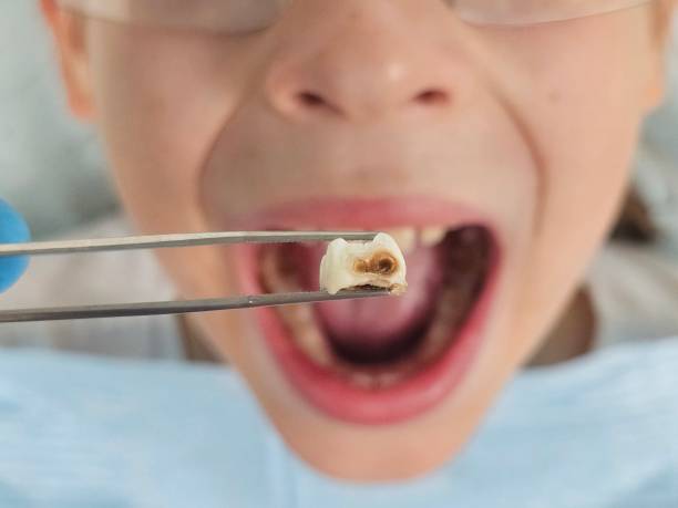 Best Emergency Treatment for Dental Infections or Abscesses in Ashaway, RI